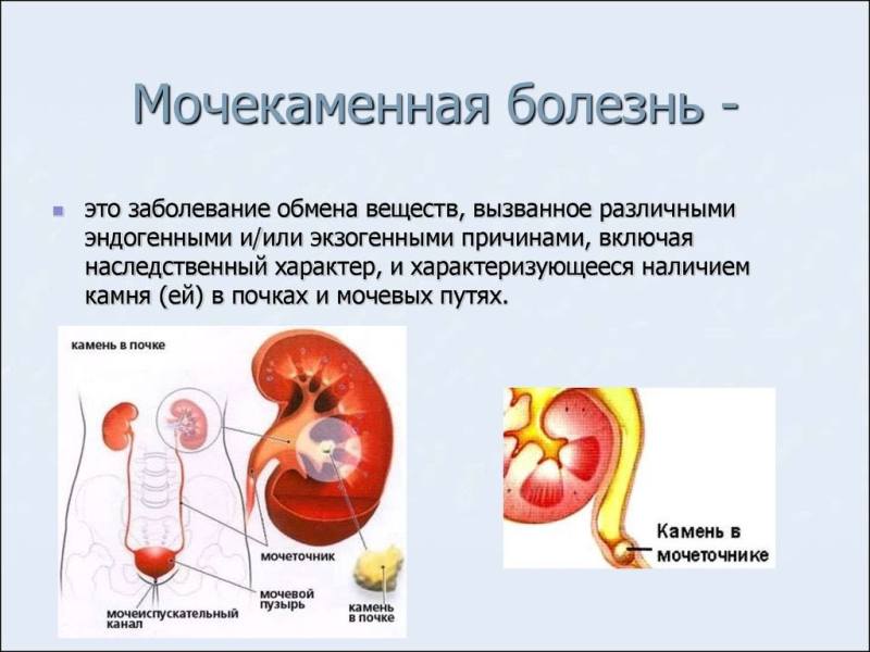 От чего появляются камни в почках и как ускорить выход камня из почки