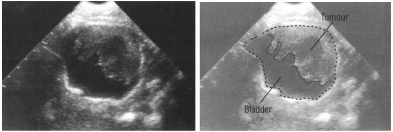 Опухоль в мочевом пузыре: снимок - 2