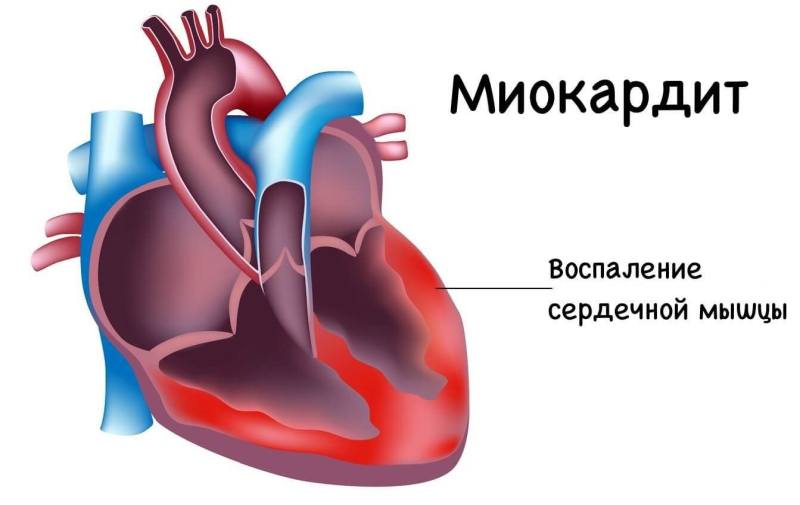 Миокардит: строение сердца - 1