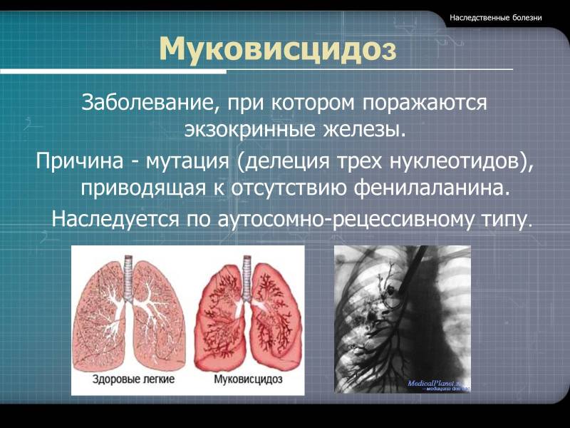Муковисцидоз: клиническая картина заболевания - 1 Муковисцидоз: клиническая картина заболевания - 1