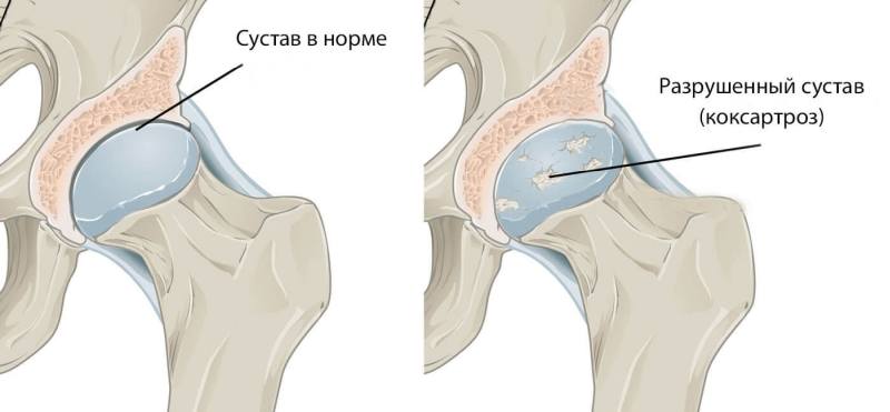 Боли в коленном суставе