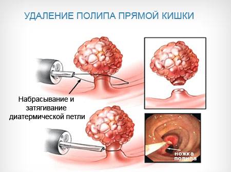 Как лечить заболевание? - 3
