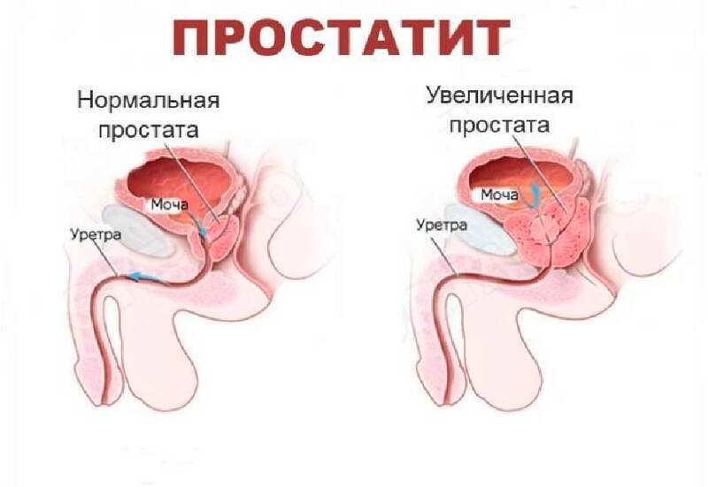 МИТОМИЦИН: Как убрать послеоперационный рубец Заболевания