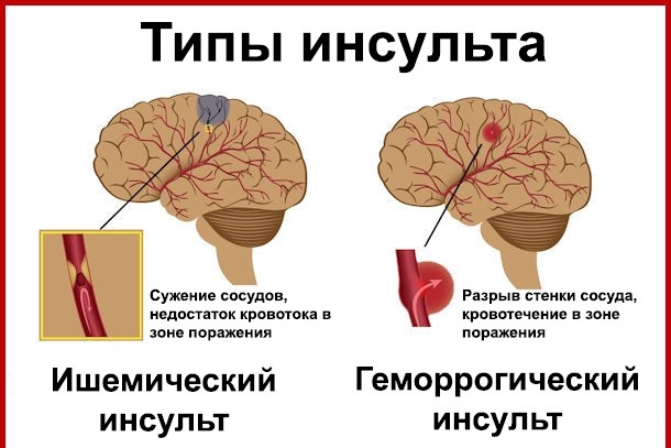 Инсульт - 3