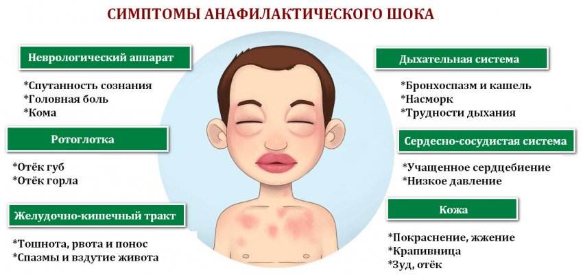 Основные симптомы аллергического отека Квинке - 3