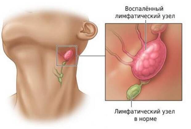 Воспалился лимфоузел за ухом