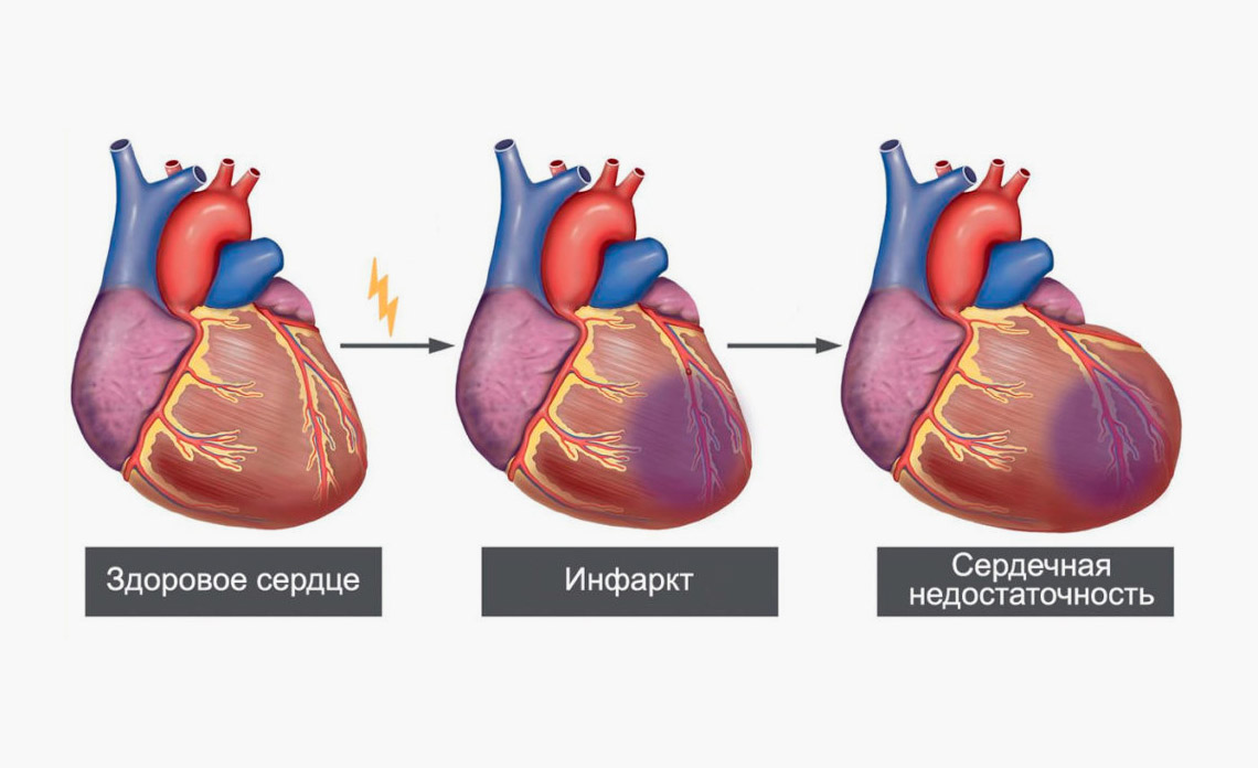 Инфаркт миокарда - 2