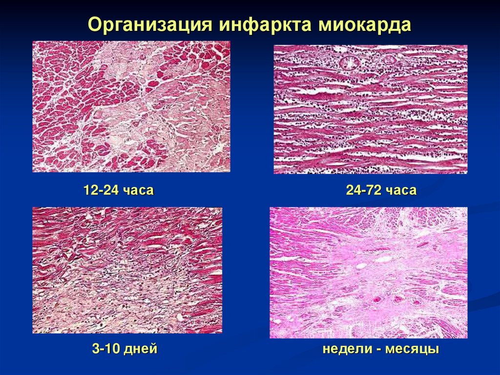 Инфаркт миокарда - 3
