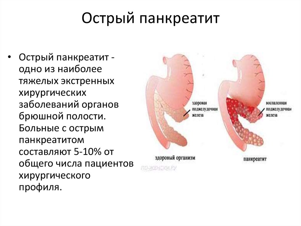Острый панкреатит - 1