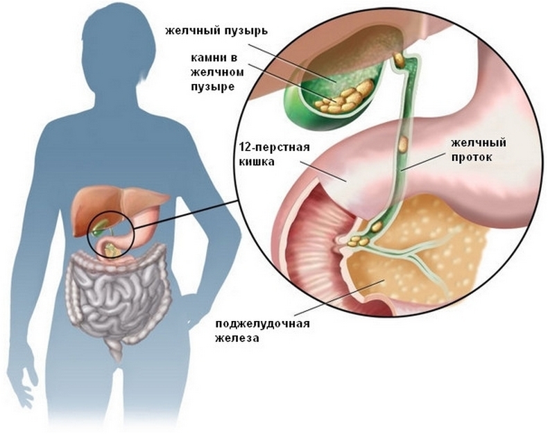 Камни в желчном пузыре - 2