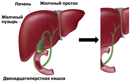 Удаление желчного пузыря - 3