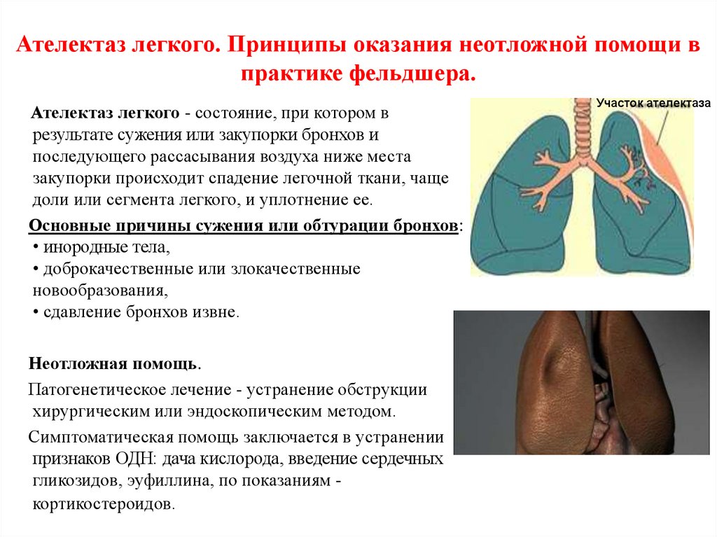 Диагностика причин ателектаза легкого