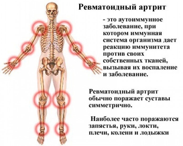 Советы ревматолога пациентам с ревматическими заболеваниями