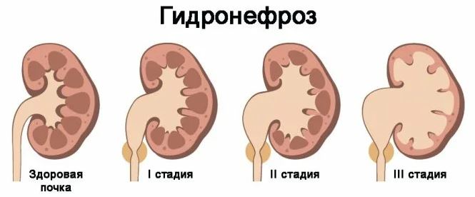 Гидронефроз - 2