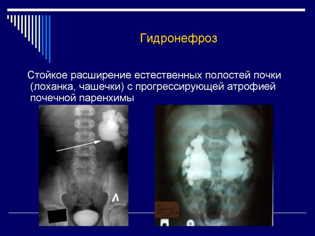 Гидронефроз - 3