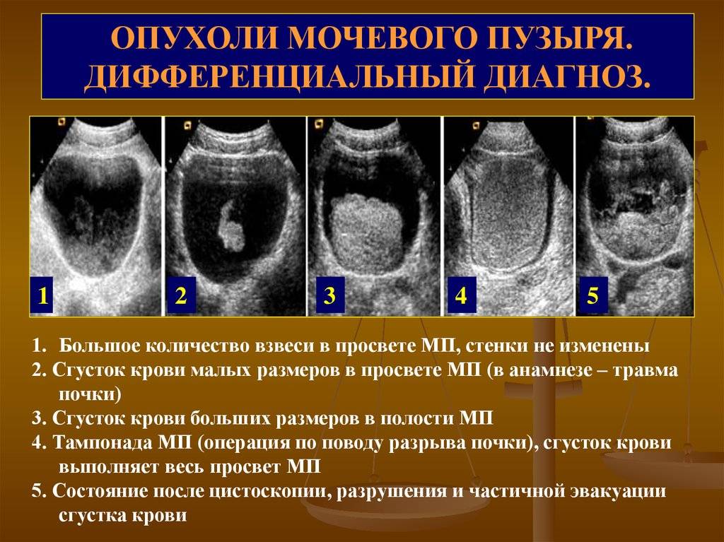 Доброкачественные опухоли мочевого пузыря - 2