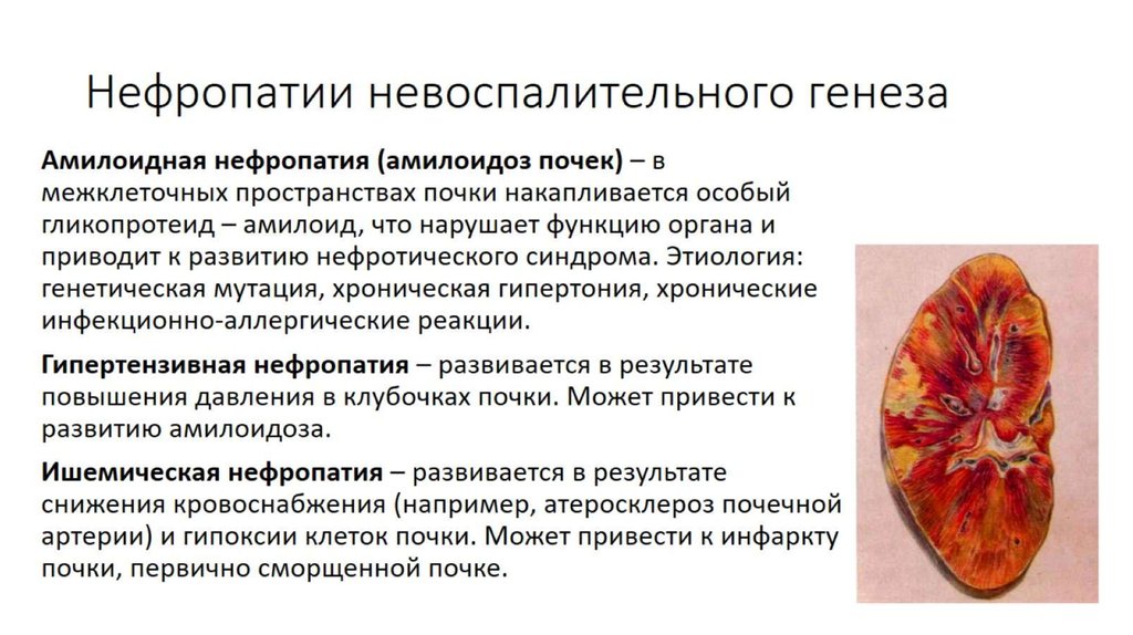 Алкогольная нефропатия - 1