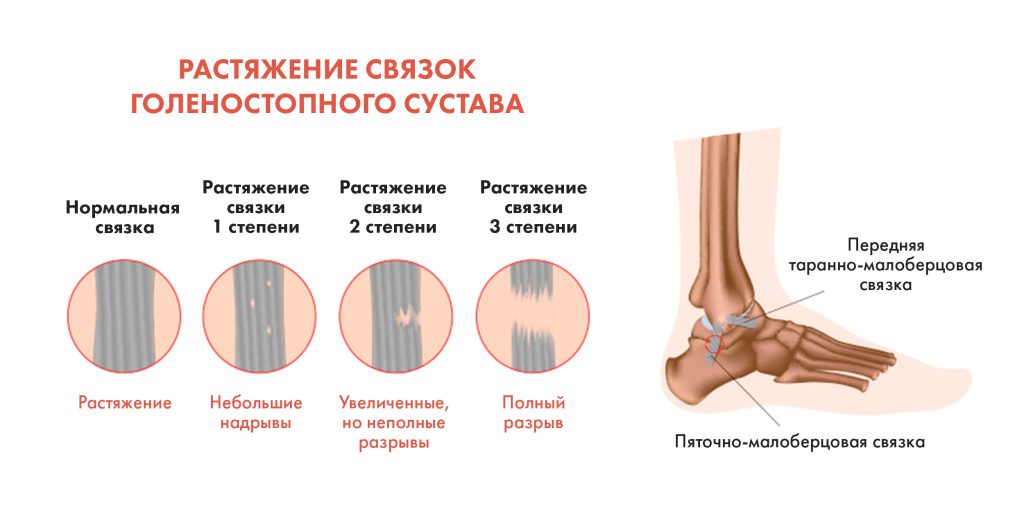 Вывих голеностопного сустава - 2 Вывих голеностопного сустава - 2