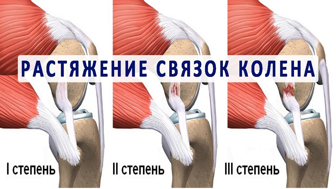 Растяжение связок - 3 Растяжение связок - 3