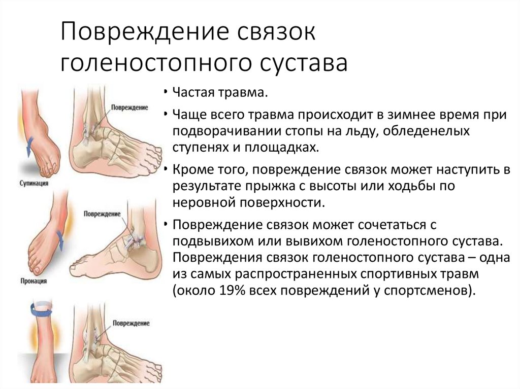 Растяжение связок - 1 Растяжение связок - 1