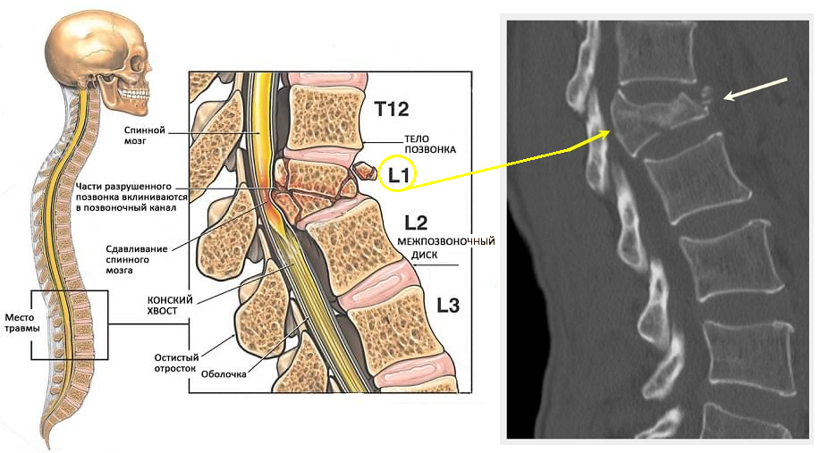 Компрессионный перелом позвоночника поясничного отдела: лечение