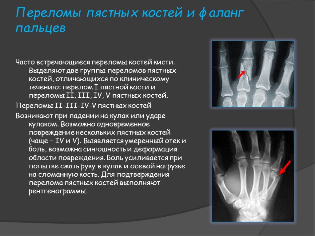 Перелом пальцев кисти - 2