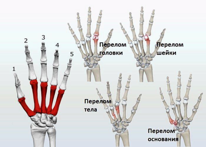 Перелом пальцев кисти - 3