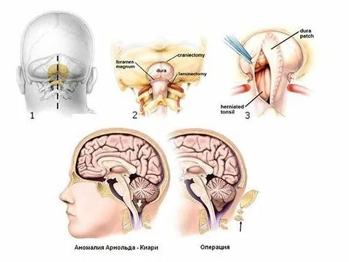 Синдром Арнольда Киари (мальформация или аномалия Арнольда Киари)