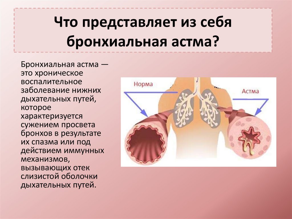 Бронхиальная астма - 2