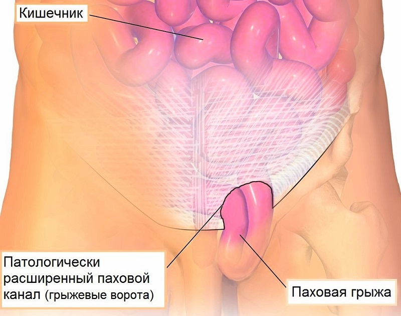 Паховая грыжа - 2 Паховая грыжа - 2