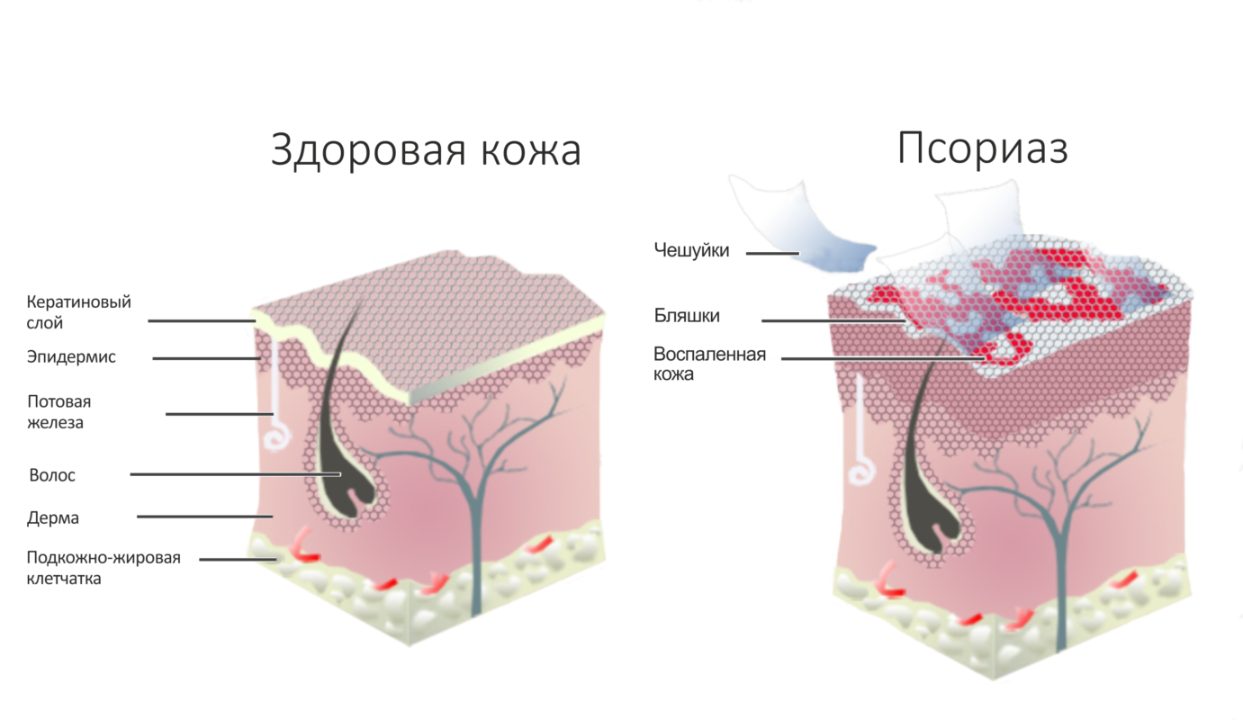 Псориаз - 2