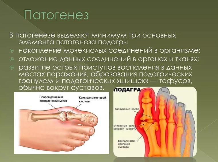 Подагра - 2