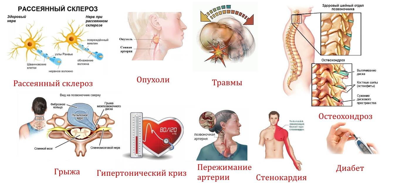 Рассеянный склероз - 1 Рассеянный склероз - 1