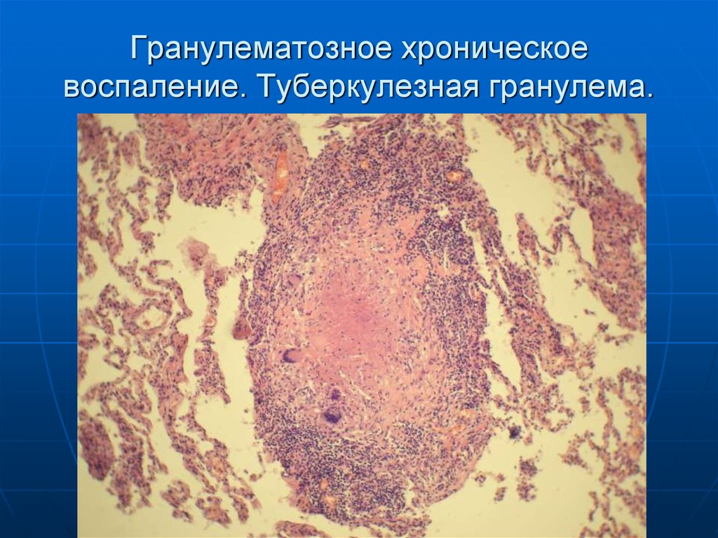 Хроническая грануляматозная болезнь - 1